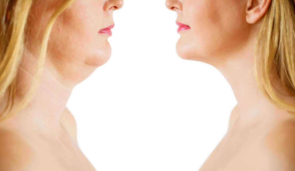 Double Chin treatment Dartford before and after results