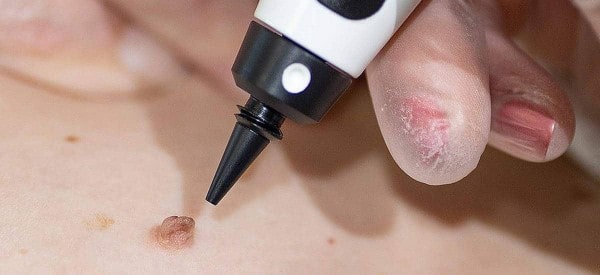 After Skin Tag Removal Dartford