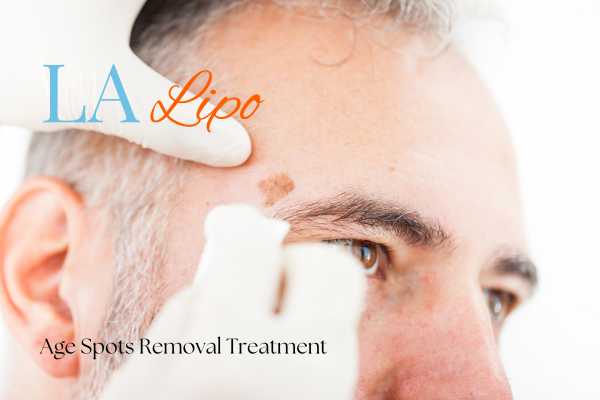 What Are the Most Effective Treatments for Age Spots Dartford?