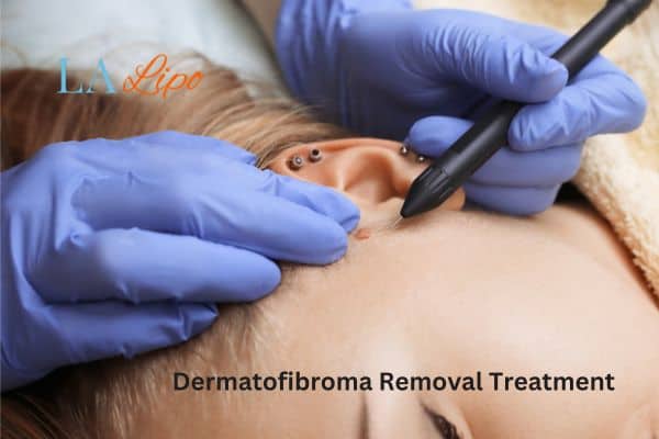 Dermatofibroma Removal Treatment Dartford