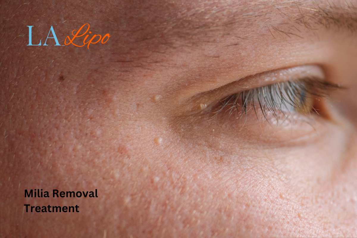 Cryopen Milia Removal: Is It the Easiest and Safest Option Dartford?