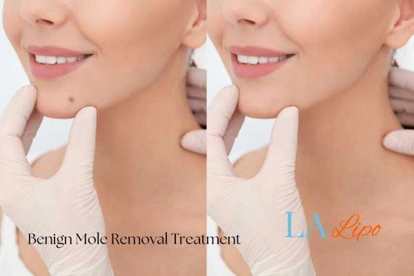 woman's before and after mole removal Dartford results