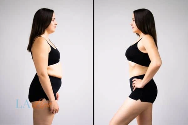 image of woman before and after results of LA-EMS Body Sculpting Dartford to help treat Diastasis recti