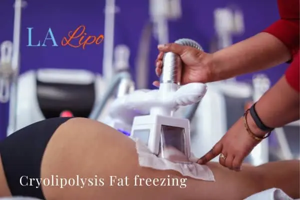 women getting fat freezing Dartford