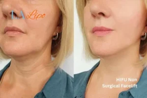 hi-fu for wrinkles Dartford before and after results
