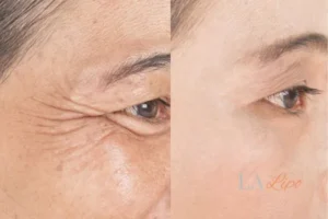 Before and after results of woman - HI-fu wrinkles reduction treatment Dartford