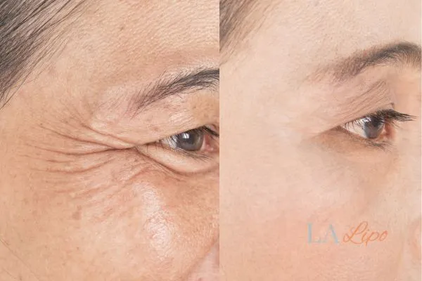 Before and after results of woman - HI-fu wrinkles reduction treatment Dartford