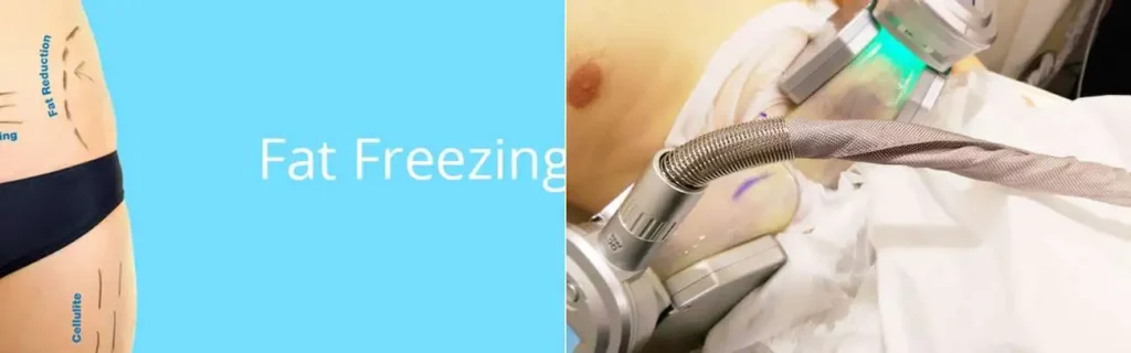 Fat freezing Dartford on multiple areas of the body