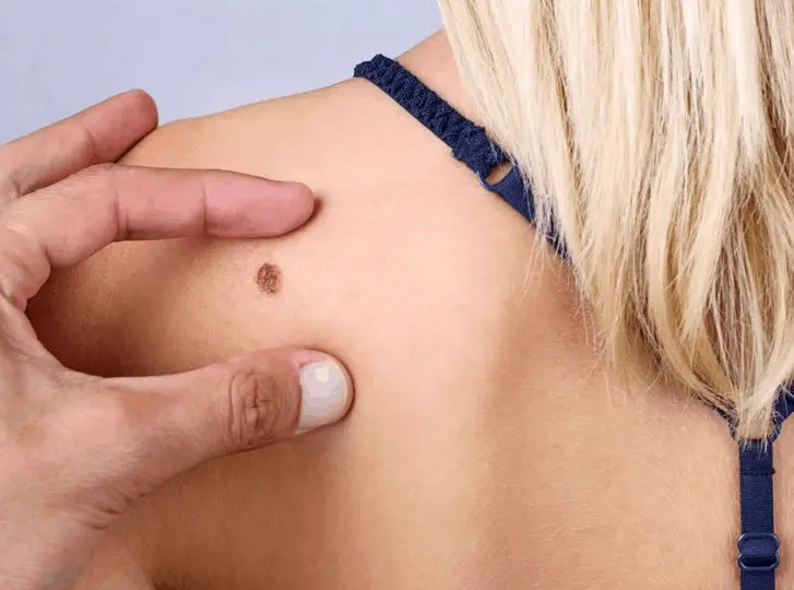 woman having mole removal Dartford consultation before treatment.