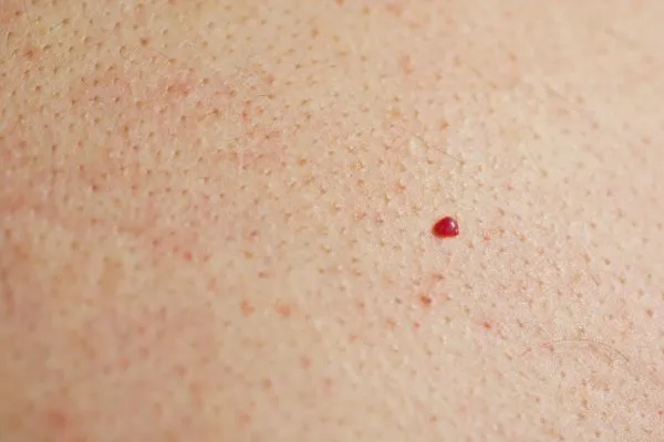 close up of a cherry angioma Dartford