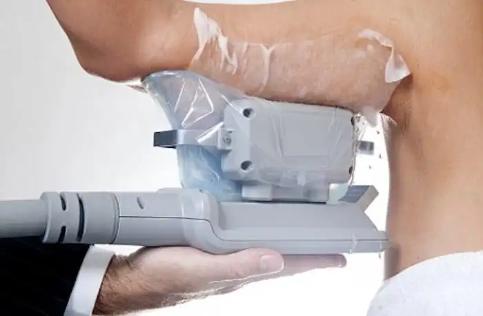 Picture of fat freezing Dartford on the upper arms.