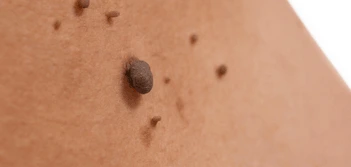image of a skin tag Dartford