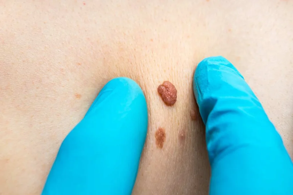 Consultant examining a skin tag Dartford