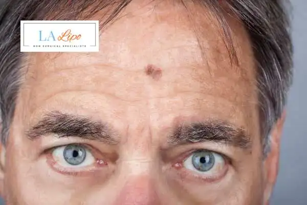 Solar Lentigo Removal Dartford image of man with mark on his forehead