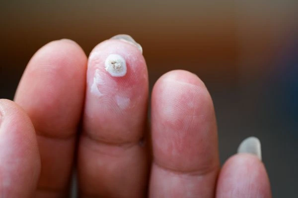 wart on person finger - cryotherapy to treat from LA LIPO Dartford