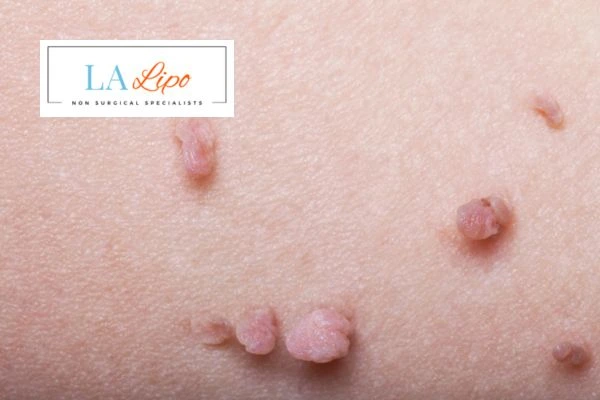 Does cryopen skin tag removal Dartford hurt? Find out now call our team today!