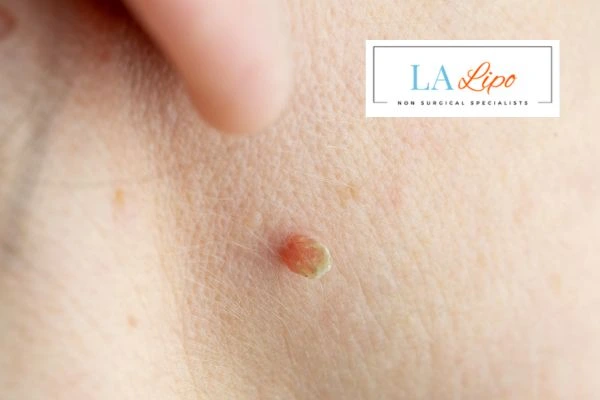 Book skin tag removal Dartford today speak to our team now!