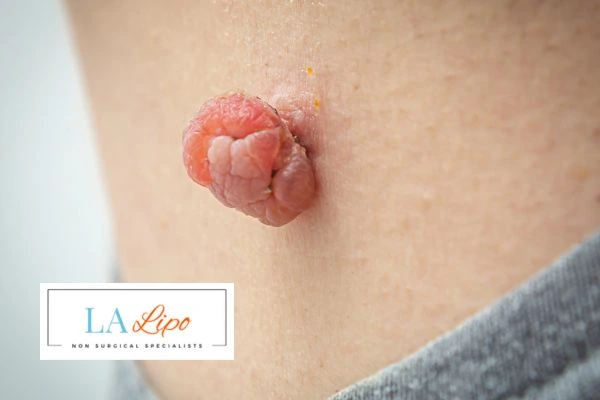 Interested in skin tag removal Dartford? Concerned about the pain? Find out more today!