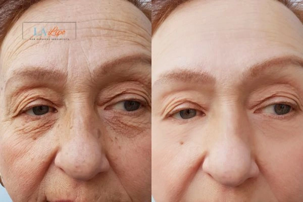 The powerful benefits of Morpheus8 Treatment Dartford - Call Our team today!