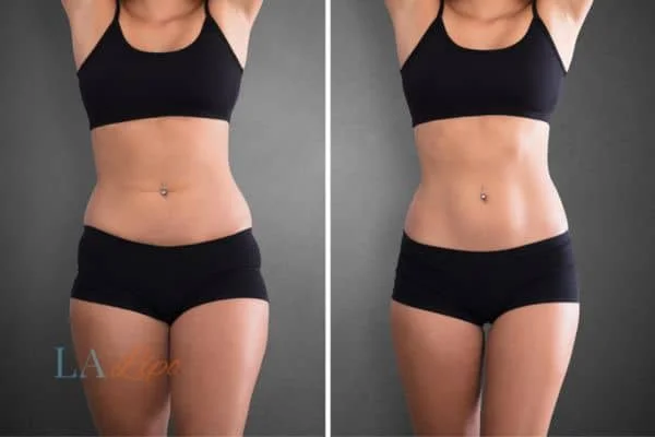 before and after results of non-surgical treatment to help a woman's body image and mental health Dartford