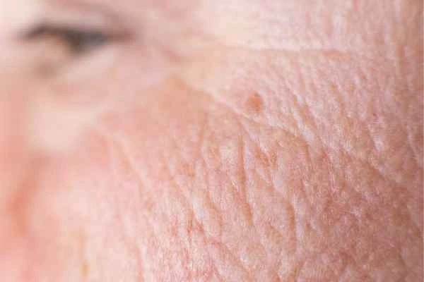 close up picture of a woman's face showing an age spot Dartford