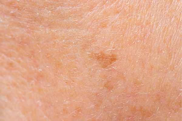 close up picture of age spots Dartford