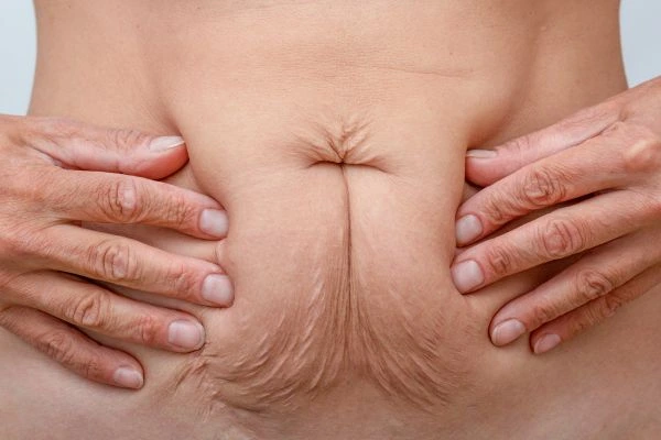 Image of a woman's stomach with loose skin - example of skin tightening Dartford options